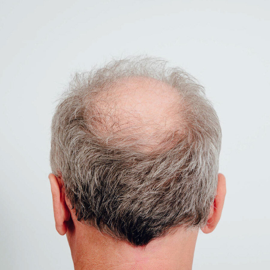 Paquete Alopecia